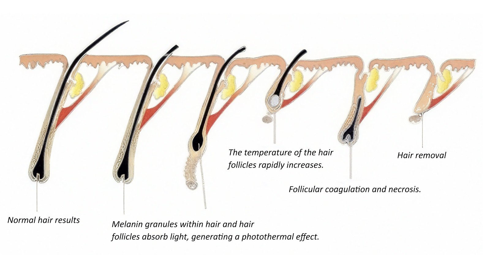 Hair removal ,skin whitening Hair removal ,skin whitening