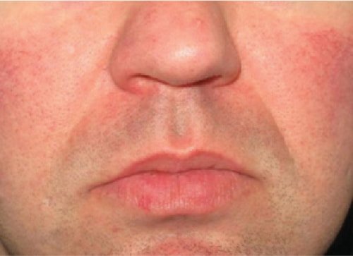 Tratamiento vascular 2 antes