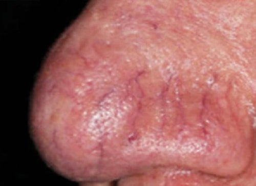 Tratamiento vascular 2 antes