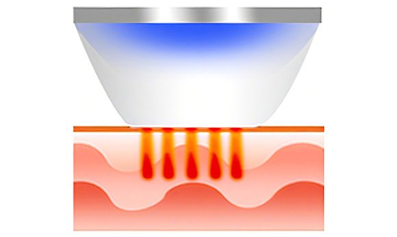 Comienza el proceso de regeneración de colágeno y producción de nuevo elástico.