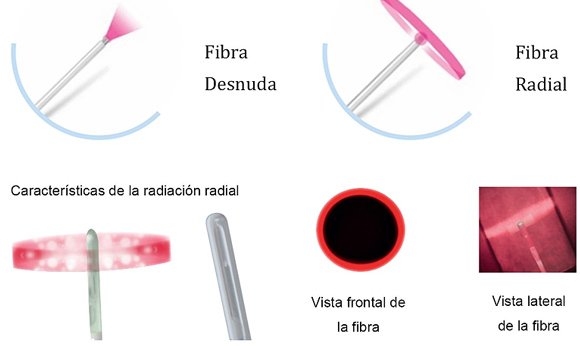 Las fibras ópticas Endolift Micro están disponibles en dos tipos: desnudas y radiales.