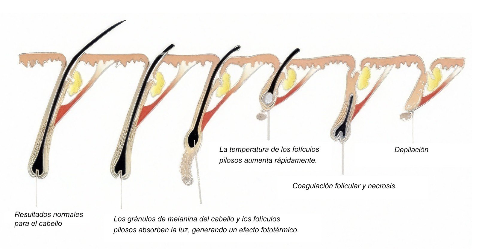 Hair removal ,skin whitening西班牙语