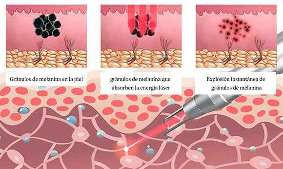 Cómo funcionan los láseres de picosegundos?