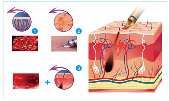 Cómo funciona el tratamiento para el enrojecimiento facial?