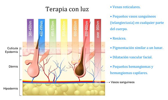 Vascular lasers are designed to eliminate these types of vascular lesions
