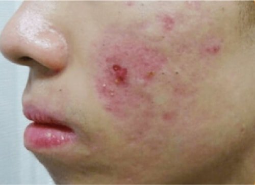 Acne Treatment Before