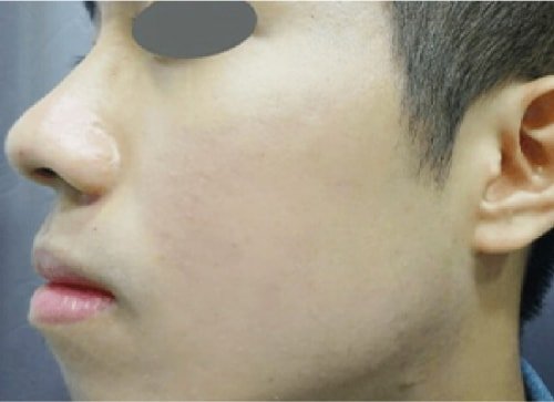 Acne Treatment After
