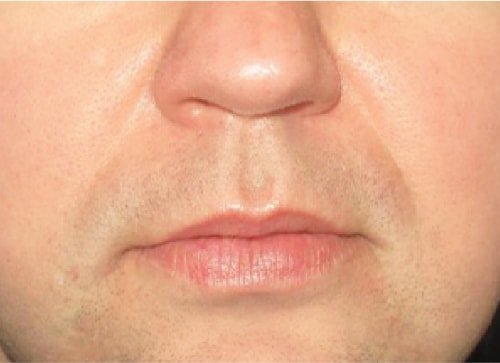 Vascular Treatment 2 After