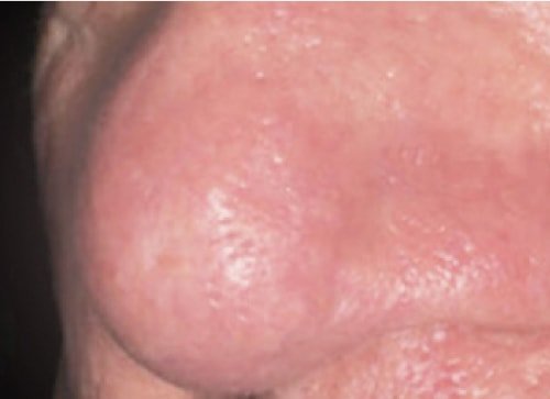 Vascular Treatment After