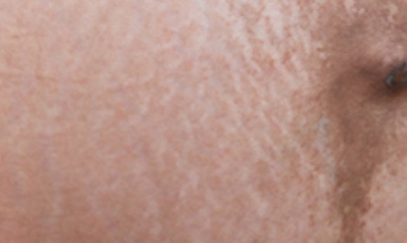 Stretch marks