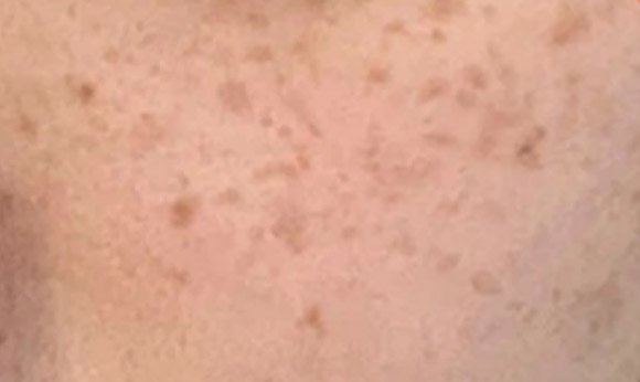 Treatment of pigmentation