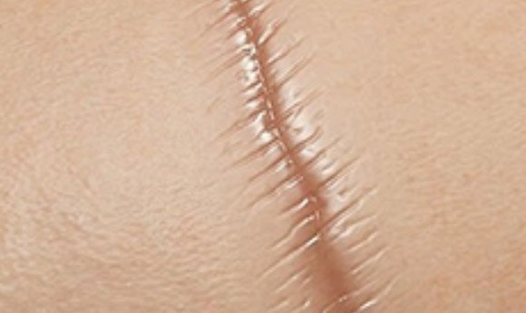 Scar Removal