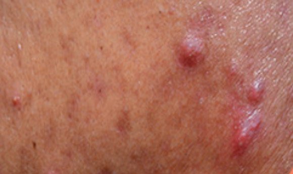 Acne RemovalAcne scar Removal