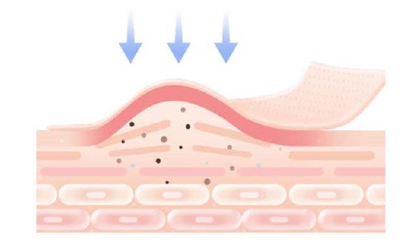 Narrow Band for Lummeca treatment